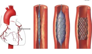 قسطره القلب 2 قسطره القلب