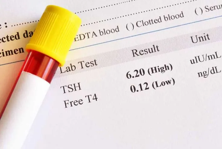 كل ما تحتاج معرفته عن تحاليل الغدة الدرقية: الأنواع والتشخيص والعلاج 2 تحاليل الغدة الدرقية