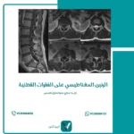 الرنين المغناطيسي على الفقرات القطنية