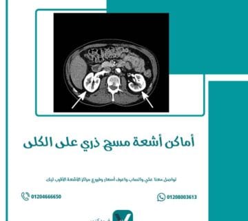 أماكن أشعة مسح ذري على الكلى