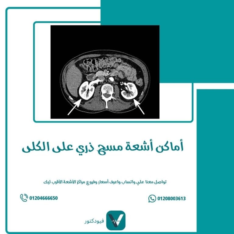 أماكن أشعة مسح ذري على الكلى