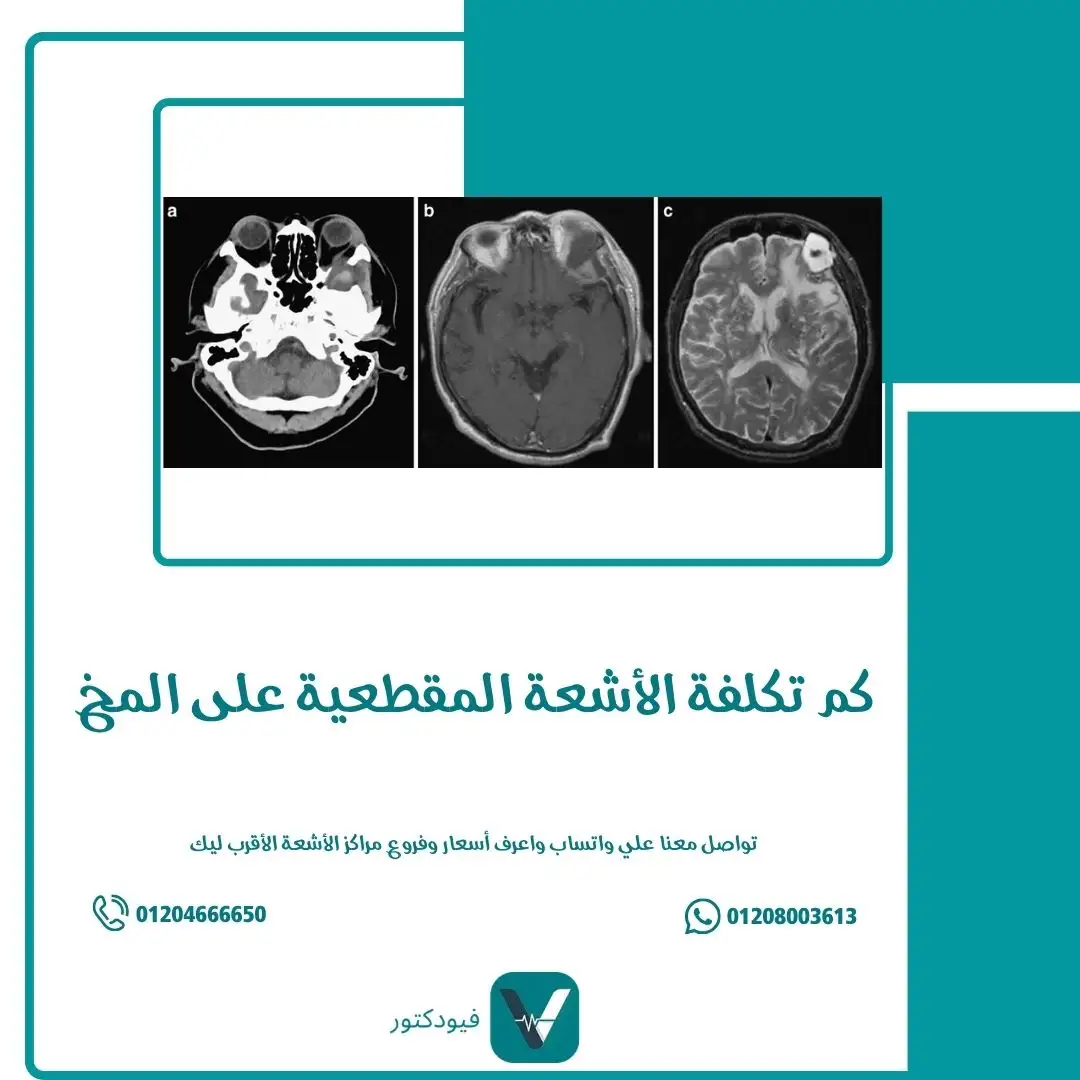 كم تكلفة الأشعة المقطعية على المخ