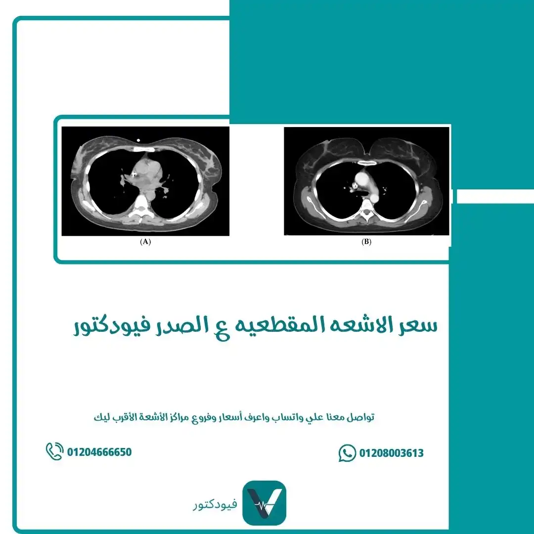 الرئيسية 29 سعر الاشعه المقطعيه ع الصدر فيودكتور