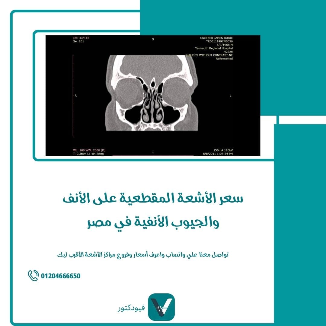 سعر الأشعة المقطعية على الأنف والجيوب الأنفية في مصر 1 الأشعة المقطعية على الأنف