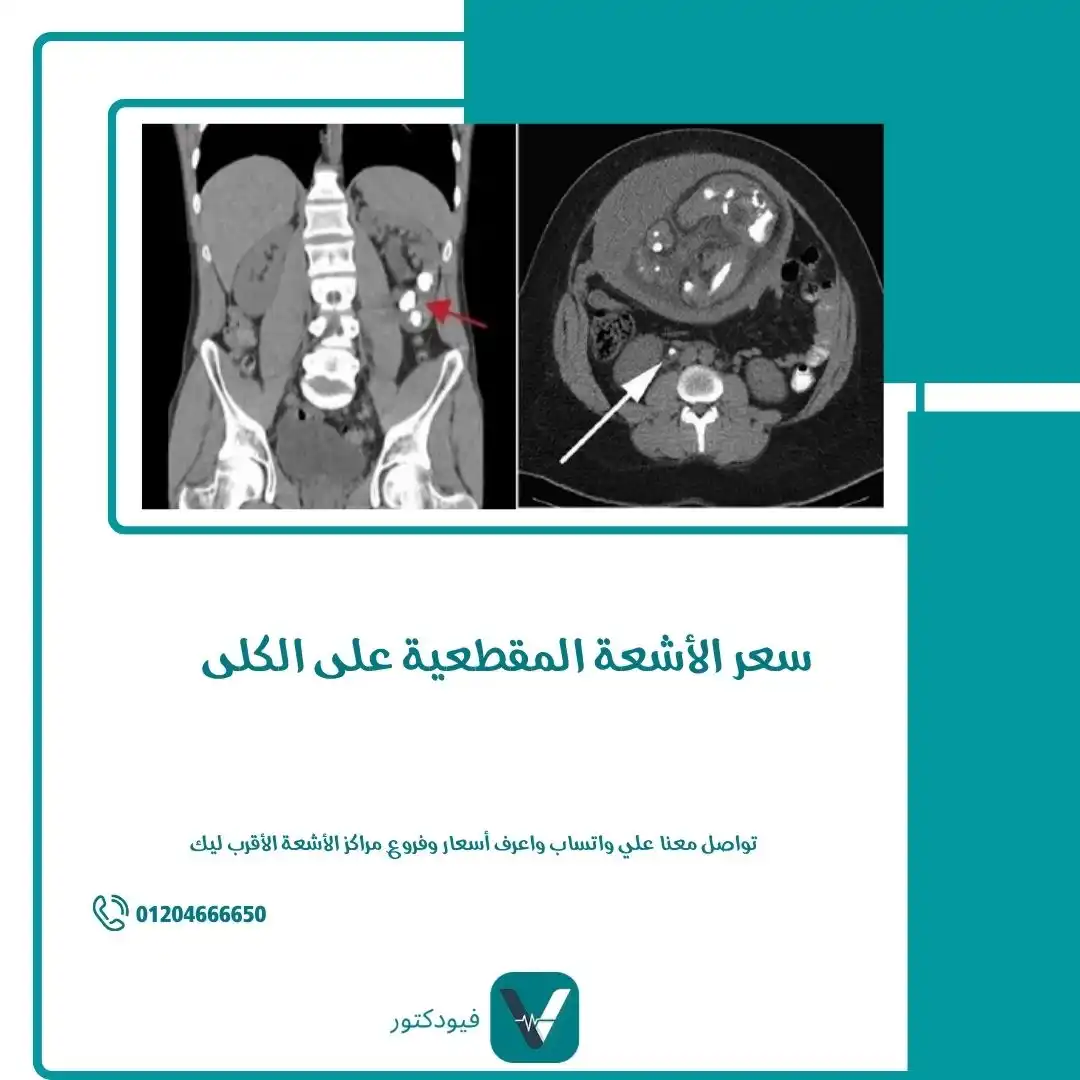 سعر الأشعة المقطعية على الكلى