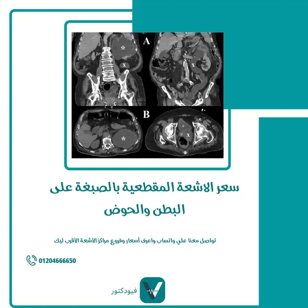 سعر الاشعة المقطعية بالصبغة على البطن والحوض