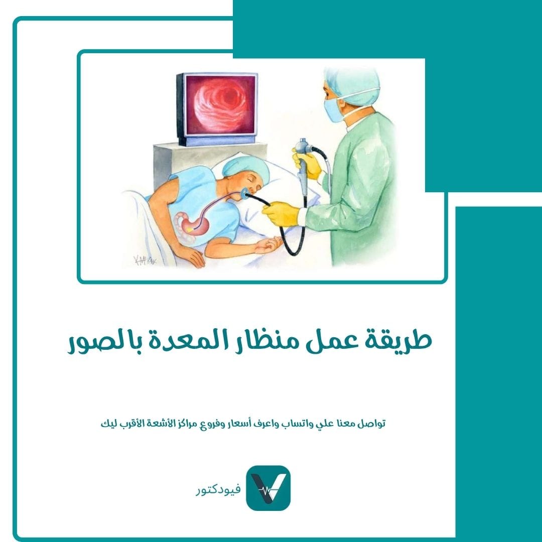 الرئيسية 29 طريقة عمل منظار المعدة